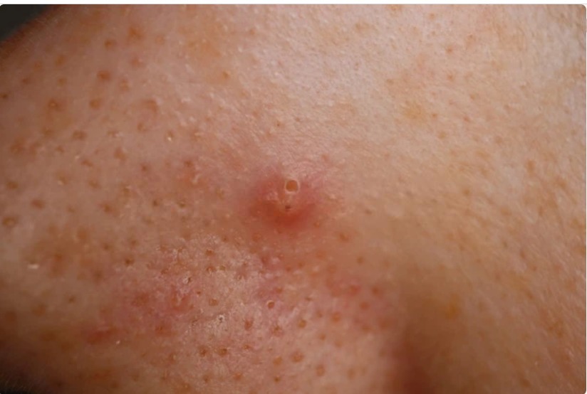 Keratin Plug Removal During Hammam Scrubs