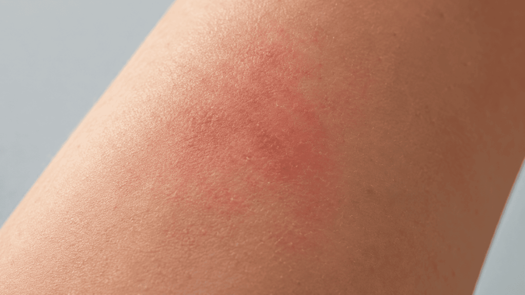 Signs that a hammam therapist is over-exfoliating the skin.